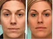 Sérum anti-âge révolutionnaire sans aiguilles - Senegal