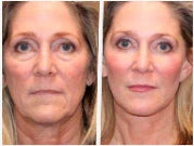 Sérum anti-âge révolutionnaire sans aiguilles - Senegal